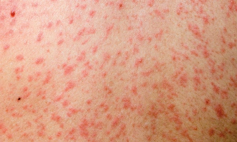 ১৯ দিনে হামের উপসর্গ নিয়ে দেশে ৯৪ শিশুর মৃত্যু