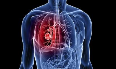 অধূমপায়ীদের মধ্যেও বাড়ছে ফুসফুসে ক্যানসার, কারণ কী