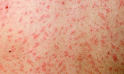 ১৯ দিনে হামের উপসর্গ নিয়ে দেশে ৯৪ শিশুর মৃত্যু